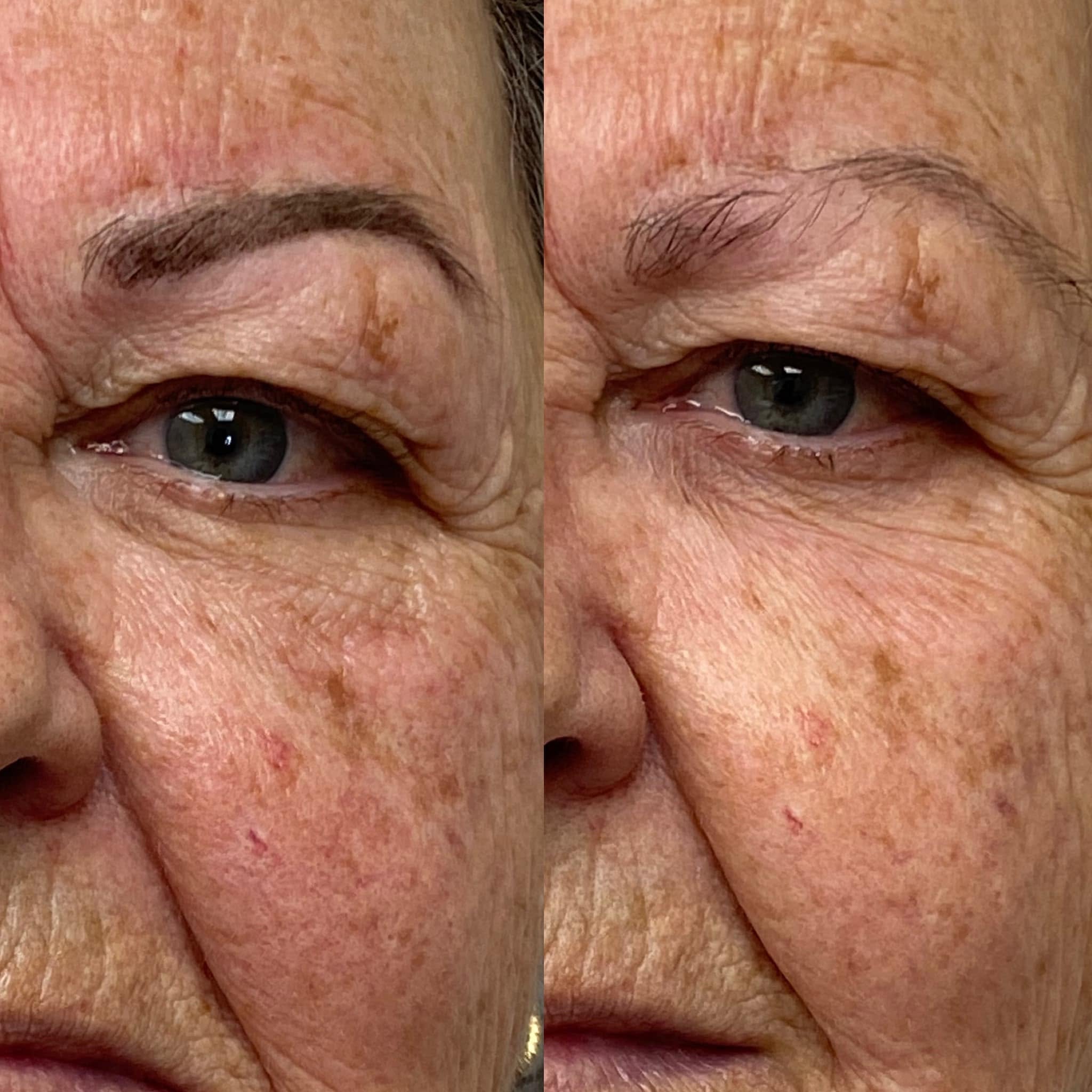 Soin anti-âge du contour des yeux — avant et après